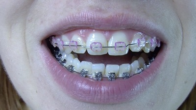 braces - g - DENTAL BRACES OF GABRIELA - B - HD 1280x720